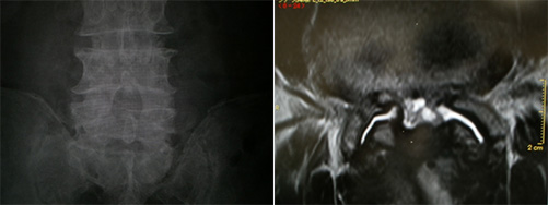 腰部脊柱管狭窄症の治療 大宮の大宮はしもと整形外科